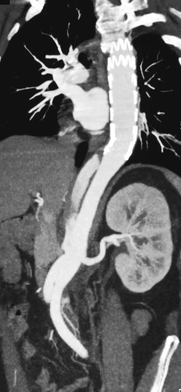 CTAkontrola rok po resekci subrenální aorty technikou aortální fenestrace s ABI rekonstrukcí
Pic. 11. A CTA check up a year after the subrenal aorta resection using the aortic fenestration technique with ABI reconstruction