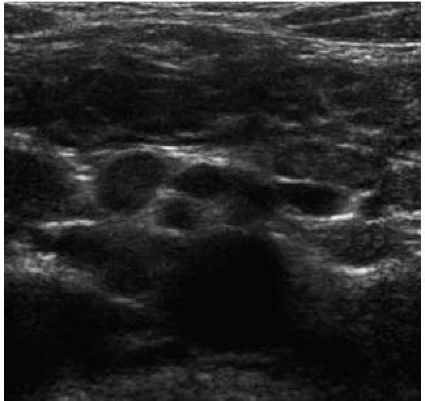 Celiakální sprue – mesenteriální lymfadenopatie.
Fig. 8. Celiac sprue – mesenterial lymphadenopathy.