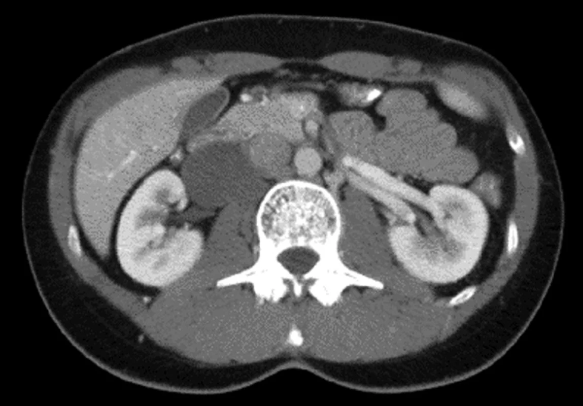Ganglioneurom retroperitonea v oblasti pravého renálního svazku (CT)
Fig. 4: Retroperitoneal Ganglioneuroma in the region of the rigth renal vessel (CT)