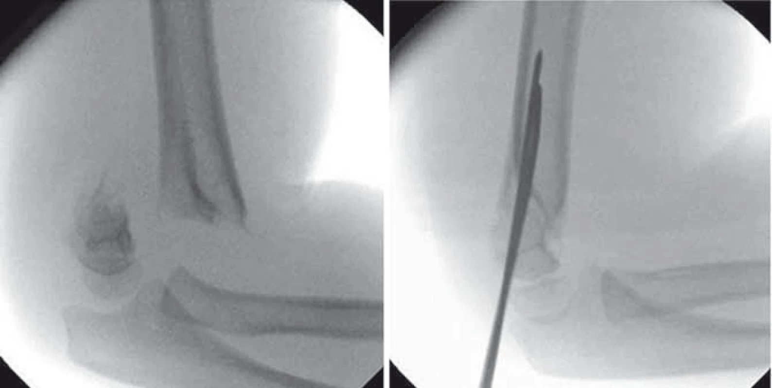 Dislokovaná suprakondylická zlomenina humeru Gartland III. stupně – před a po repozici a osteosyntéze K-dráty.
Fig. 1. Displaced supracondylar fracture of the humerus (Gartland grade III) – before and after reposition and osteosynthesis with K-wires.