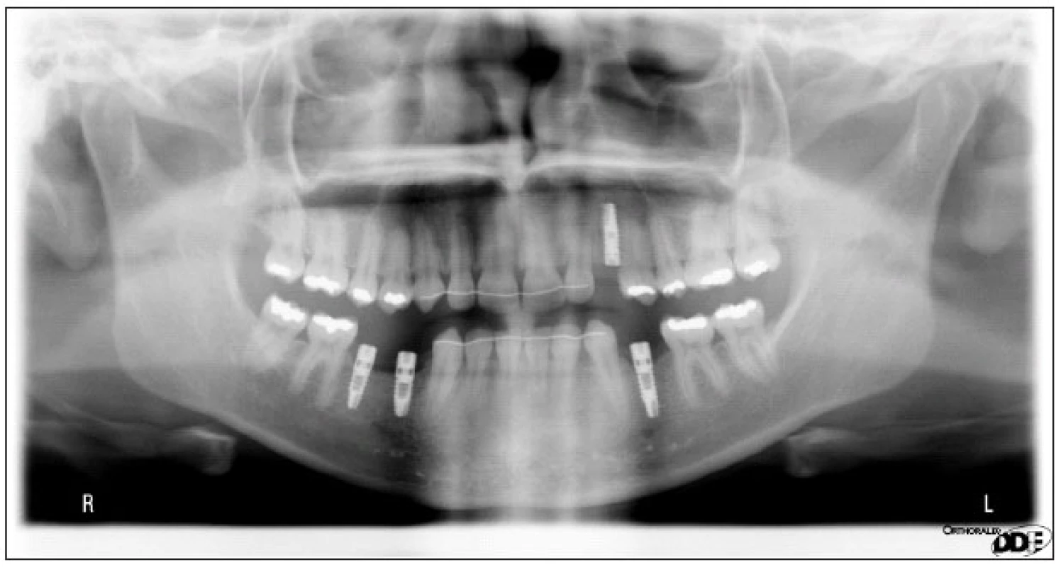 Stav po integraci implantátů v RTG obrazu.