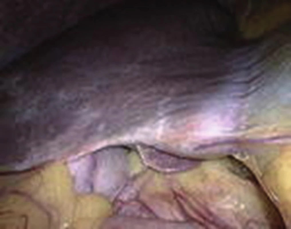 Jiný pacient s přestavbovou lézí paraligamentózně vpravo
Fig. 4: Architectural distortion to the right side of the falciform ligament in another patient