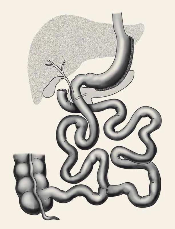 Duodenal switch.
Fig. 3. Duodenal switch.