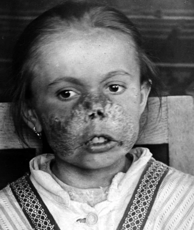 Lupus vulgaris – z vlastní dokumentace A. Trýba po založení kliniky.