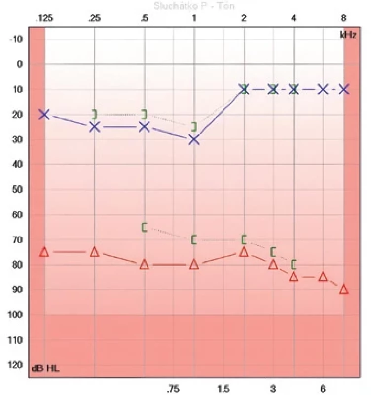 Audiogram při přijetí k došetření za hospitalizace.  Fig. 3. Audiogram at the start of hospitalization.