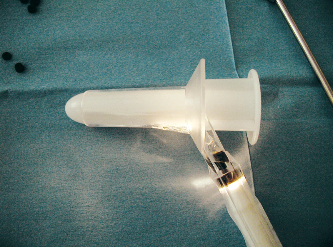 Anoskop
Fig. 3. Anoscope