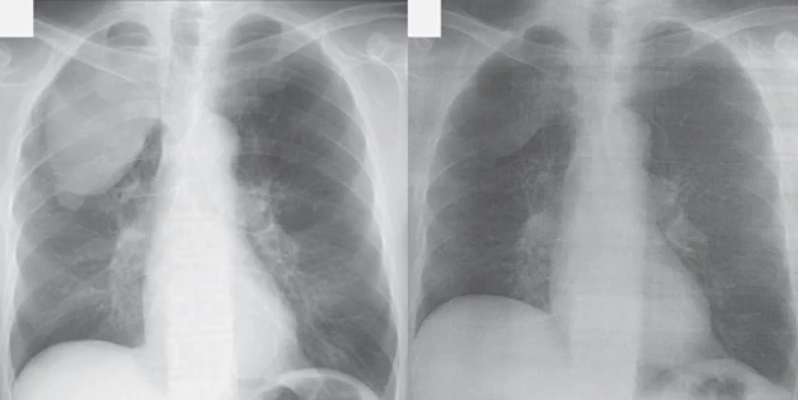 A chest radiograph taken on the day of the treatment initiation showed further growth of the mass (A). In a chest radiograph taken 25 months after the initiation of chemotherapy, a signifi cant reduction in the tumor size was confi rmed (B).