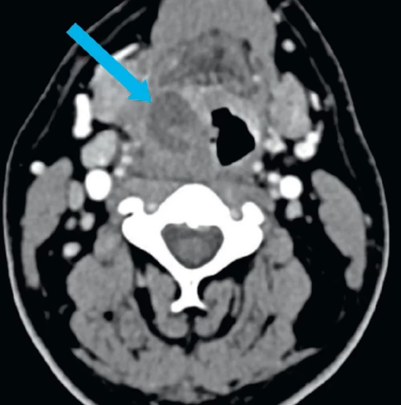 Parafaryngeální absces vpravo – šipka (CT, axiální řez). Zdroj: fotodokumentace ORL kliniky FN Plzeň.