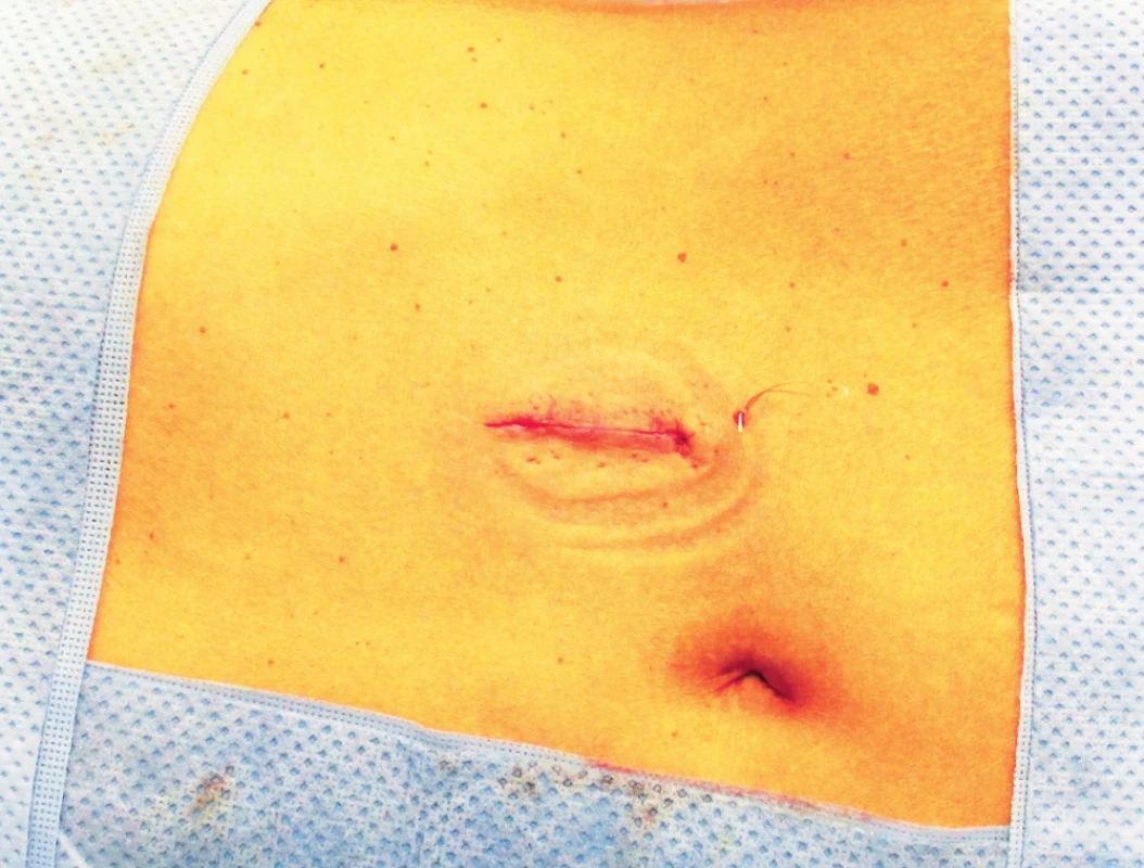 Břišní stěna po jednoportové laparoskopické (LESS) adremalektomii
Fig. 3. Abdominal wall after laparoscopic (LESS) adrenalectomy