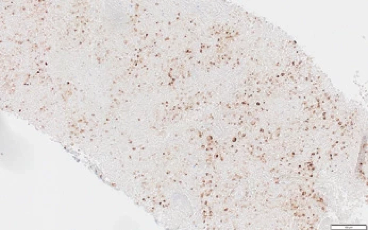 Imunohistochemie: četné nádorové buňky exprimují LMP1, protein asociovaný s přítomným Epstein–Barrové virem.