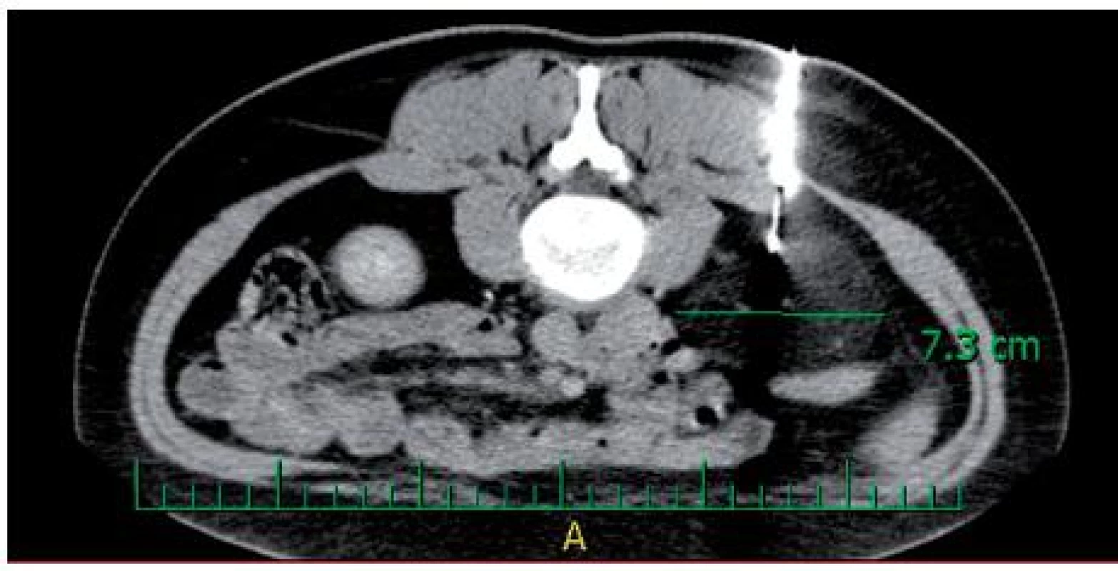 Biopsie tumoru pod CT
Fig. 2. Biopsy of tumour under CT control