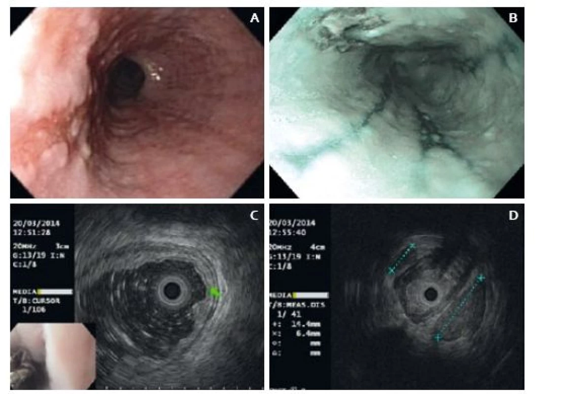 A. Endoskopický obraz léze při endosonografii, B. endoskopický obraz při kontrole po endosonografii – léze a refluxní ezofagitida v NBI, C. EUS obraz léze, D. EUS – lymfadenopatie.
Fig. 1. A. Endoscopic image of the lesion on endosonography, B. Endoscopic image during check-up after endosonography – lesion and reflux oesophagitis in NBI, C. EUS image of the lesion, D. EUS – lymphadenopathy.
