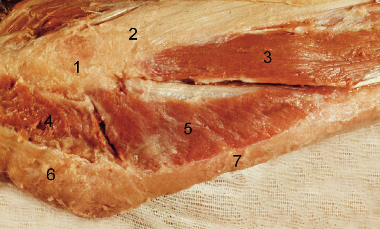 Povrchová vrstva svalů zevní plochy loketního kloubu (pravá strana): 1 – epicondylus lateralis humeri, 2 – m. extensor digitorum, 3 – m. extensor carpi ulnaris, 4 – caput radiale m. tricipitis brachii, 5 – m. anconeus, 6 – olecranon se šlachou m. triceps brachii, 7 – ulna. <i>(Převzato z Bartoníček J, Heřt J. Základy klinické anatomie pohybového aparátu. Praha, Maxdorf 2004.)</i>
Fig. 3: Superficial layer of muscles of the lateral surface of the elbow (right side): 1 – lateral epicondyle of humerus, 2 – extensor digitorum, 3 – extensor carpi ulnaris, 4 – lateral head of triceps brachii, 5 – anconeus, 6 – olecranon with triceps brachii tendon, 7 – ulna. <i>(Reprinted from Bartoníček J, Heřt J. [Outline of Clinical Anatomy of Musculoskeletal Apparatus]. Praha, Maxdorf 2004.)</i>