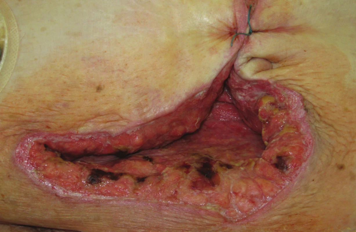 Šestý pooperační den před resuturou
Fig. 5. Postoperative Day 6, prior to resuturing