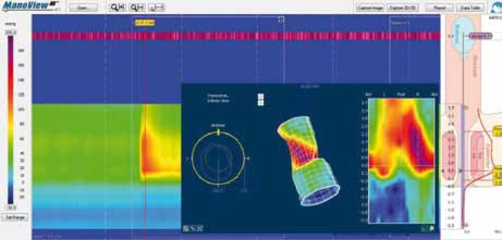 Ukázka z trojrozměrné high-resolution anorektální manometrie (ManoScan, Sierra Scientific Instruments).
Fig. 14. Sample of three-dimensional high-resolution anorectal manometry (ManoScan, Sierra Scientific Instruments).