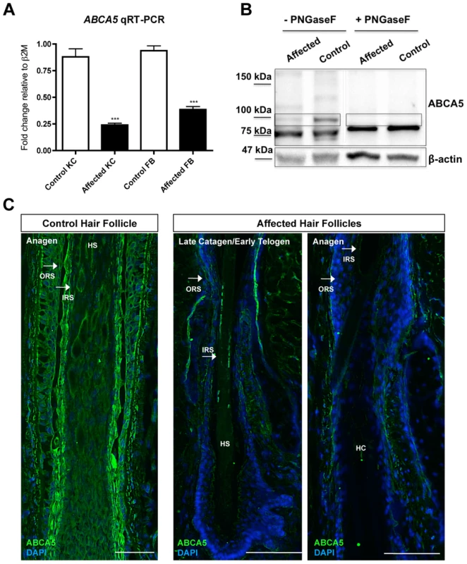 <i>ABCA5</i> levels are markedly reduced in patient hair follicles of the sporadic CGHT case.