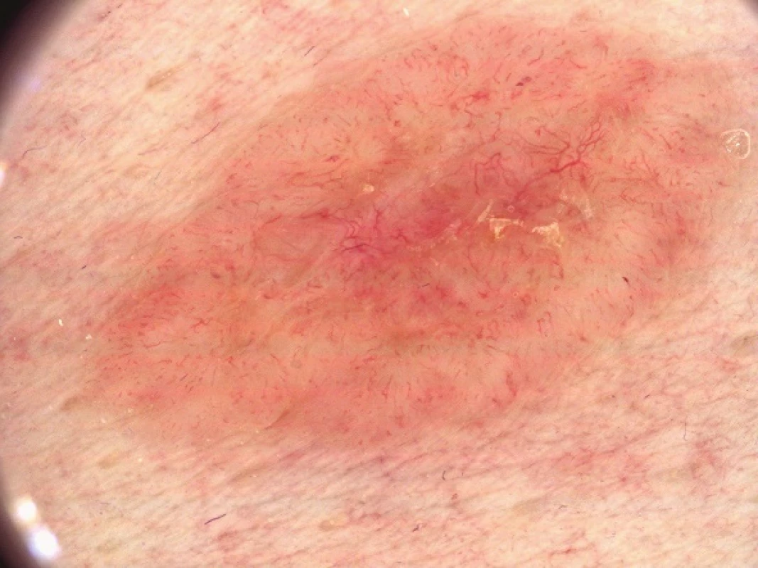 Pinkusův fibroepiteliom