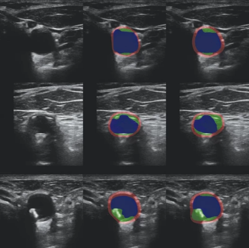 Example segmentations on the test part of the strongly labeled dataset. From the left: input image, expert segmentation, automatic segmentation.