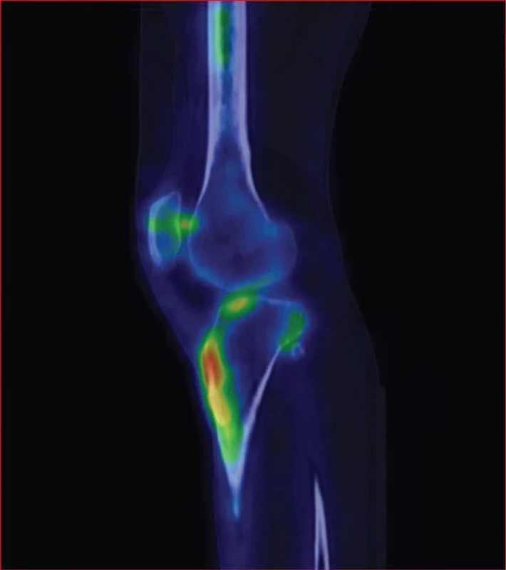SPECT/CT pravého kolenního kloubu v pozdní fázi v sagitálním řezu – lehce zvýšená akumulace radiofarmaka v kloubní ploše tibie.