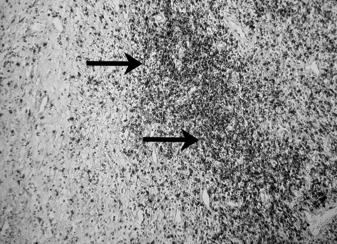 Prítomnosť T – lymfocytov v periapikálnom granulóme a ich identifikácia pomocou protilátky UCHL-1 (DAKO) – autor Ján Kováč.
Fig. 7. The presence of T lymphocytes in periapical granuloma and their identification using the UCHL-1 antibody (DAKO) – Author Ján Kováč.