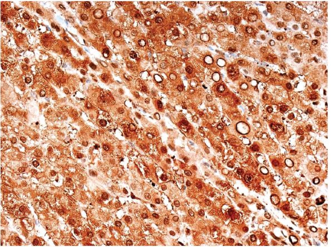Imunohistochemický průkaz L-FABP v játrech je difúzní a jeho vymizení je důležitým diagnostickým znakem H-HCA.