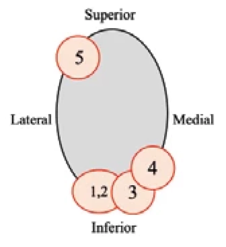 Topographic representation of pedicle screw breaches.