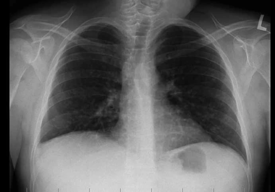 Sumační snímek hrudníku – retrospektivní popis: V obou plicních křídlech mnohočetná drobná, místy až splývající ložiska do vel. 8 mm. Srdeční stín je normální velikosti a konfigurace. Mediastinum nerozšířeno. Hily cévně konfigurované, pravý masivnější. Cévní kresba přiměřená. Bránice je hladká, v obvyklé výši. Zevní brániční úhel vpravo lehce otupen, vlevo volný. Zachycený skelet bez patologických změn. Re: drobněložiskový proces v obou plicních křídlech – miliární MTS diseminace v.s., otupený zevní brániční úhel vpravo.