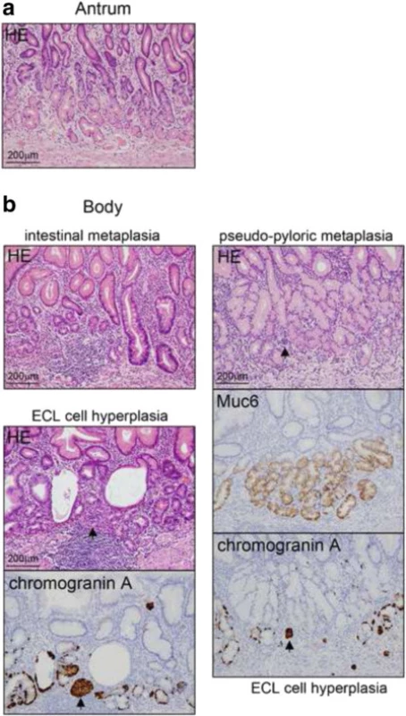 Examination of the background mucosa. a. The proper gastric glands in the pyloric region were preserved. There was no atrophic change. b. The proper gastric glands in the gastric body. The mucosa was atrophic and showed intestinal metaplasia and pseudo-pyloric metaplasia. Muc6 is a gastric pyloric gland- type secretory mucin. Enterochromaffin-like cell hyperplasia (linear hyperplasia and micronodular hyperplasia (arrows)) was revealed by chromogranin A staining