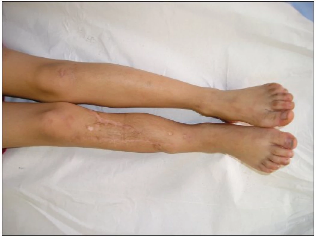 Clinical outcome – two years follow-up