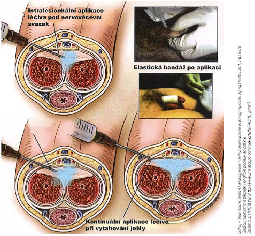 Intralesionální aplikace (3)
Fig. 10 Intralesional therapy (3)