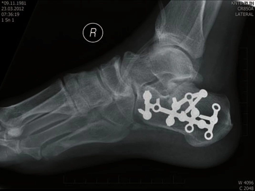 Osteosyntéza LCP Synthes - laterální projekce