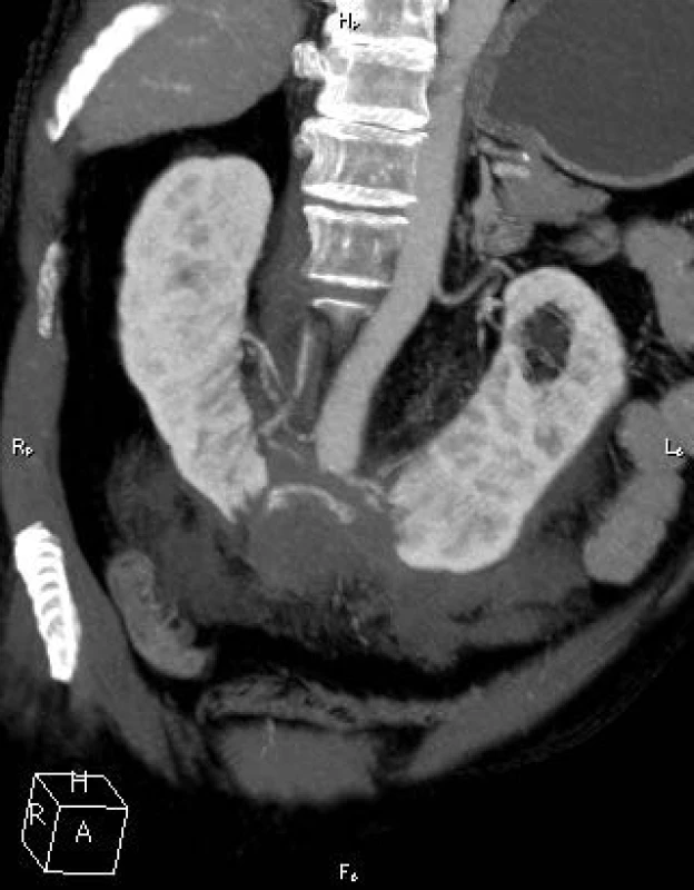V retroperitoneu vlevo se nalézal při psoatu objemný hematom o velikosti asi 16x12x10 cm
Fig. 1. Retroperitoneal hematoma size 16x12x10 cm