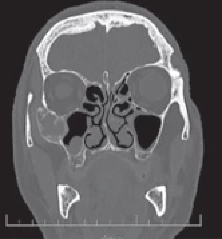 Pre-operative MRI – second case.