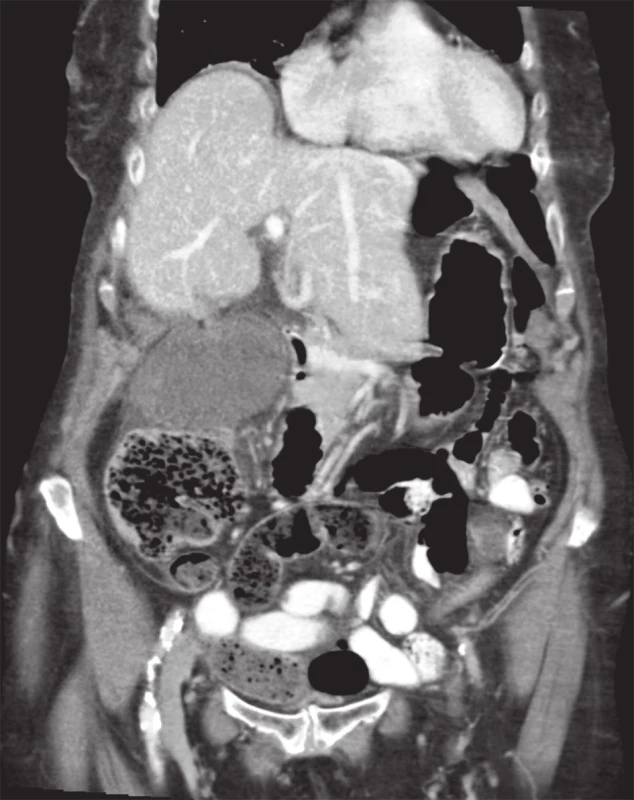 Hydropický žlučník se ztluštělou stěnou, uložený vedle stěny břišní. Cholecystolithiasa není patrná.
Fig. 5: The hydropic gallbladder, with a thickened wall and positioned adjacent to the lateral abdominal