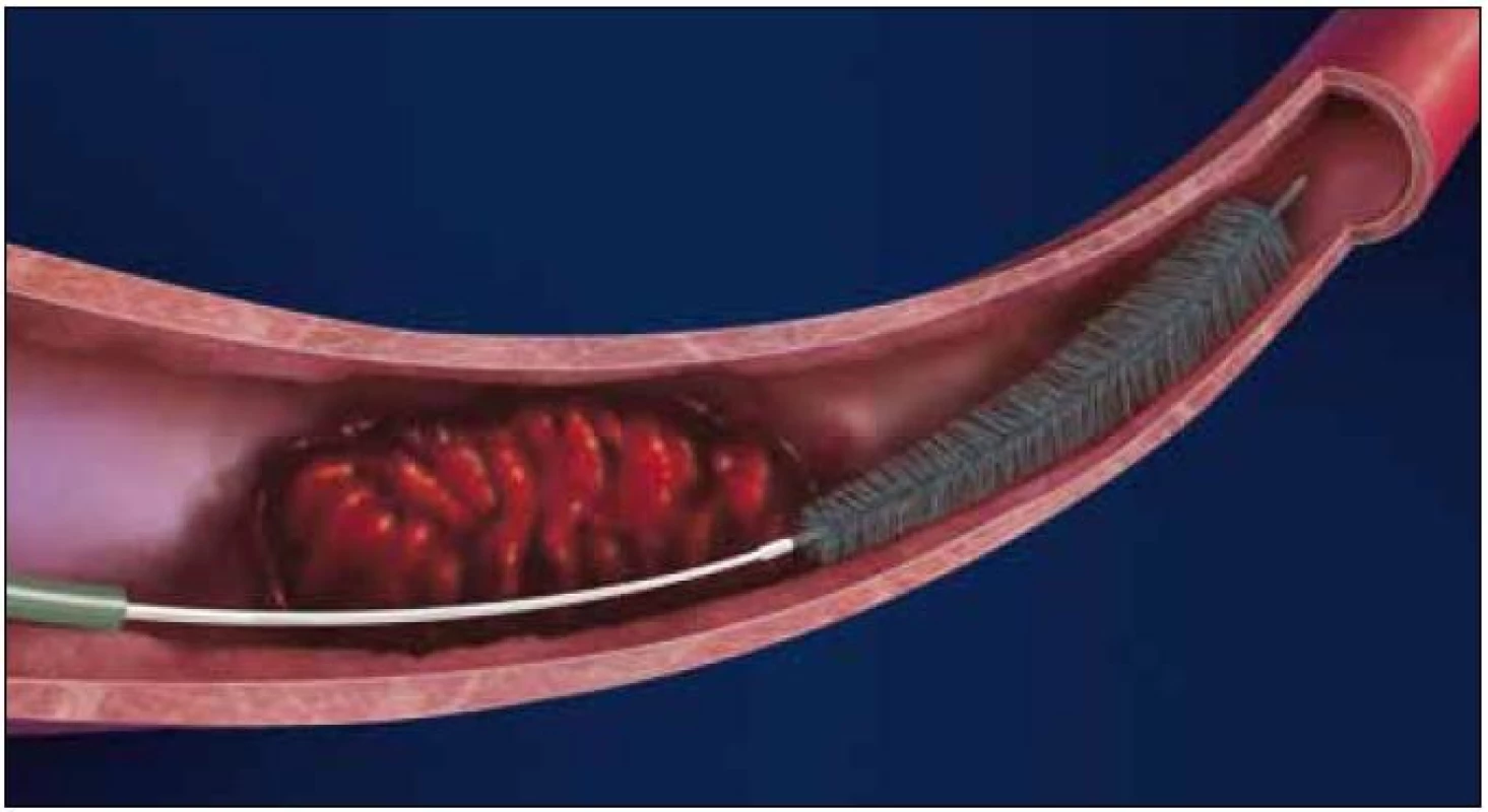 Phenox Clot Retriever – pCR<sup>®</sup> (Phenox GmbH, Bochum, SRN).
Available from: URL: http//www.phenox.info.
