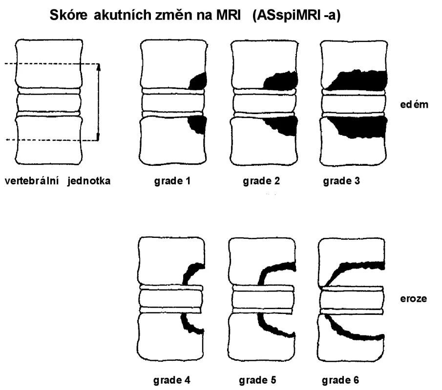 Skóre akutních a chronických změn hodnocených MR. Modifikováno dle Brauna a kol. (7).
• skóre akutních změn (ASspiMR-a) 
0 = normální nález, bez léze 0 = normální nález, bez léze
1 = mírný edém kostní dřeně, < 25 % 
2 = střední edém kostní dřeně, < 50 % 
3 = velký edém kostní dřeně, > 50 % 
4 = drobná eroze, < 25 % 
5 = střední eroze, > 25 % ale < 50 % 
6 = velká eroze, > 50 % 
• skóre chronických změn (ASspiMR-c)
1 = mírná sklerotizace, suspektní změny
2 = sklerotizace/kvadratizace/poč. syndesmofyty
3 = 1–2 syndesmofyty/malé eroze
4 = dva a více syndesmofytů/discitida/několik erozí
5 = přemosťující syndesmofyty
6 = vertebrální fúze