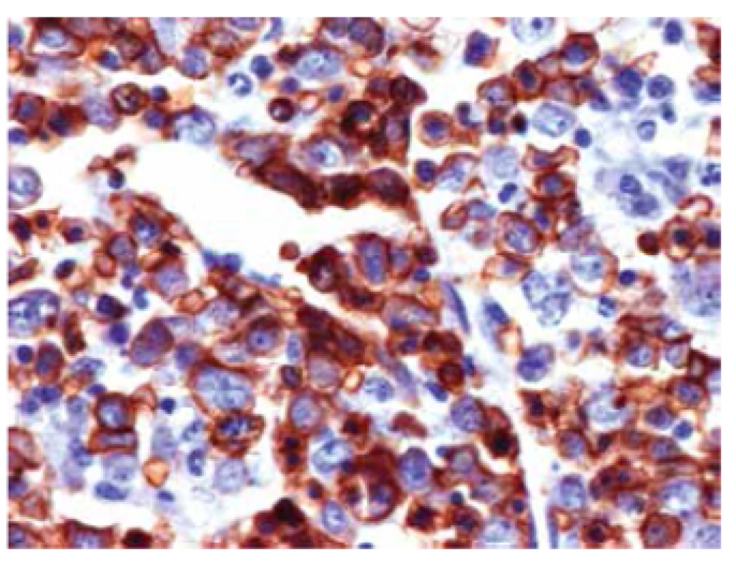 Trepanobioptický nález: Imunohistochemické vyšetření na glykoforin (marker erytrocytové linie, hnědě pozitivní), 400x
