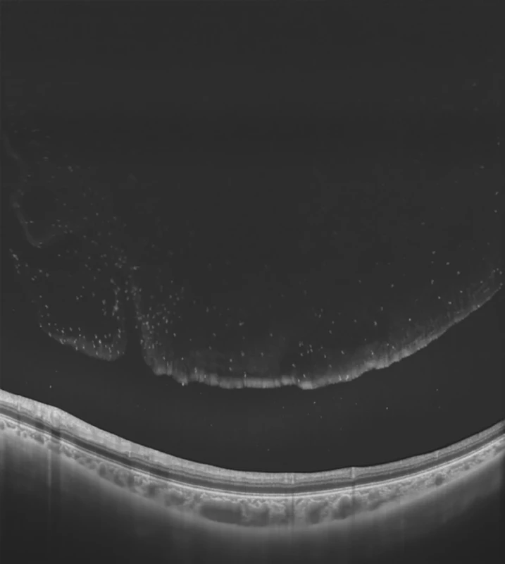 Hlboký, 12  mm rez sietnicou, so zvýraznenými hyperreflektivitami v sklovcovom priestore pacienta s vitritídou