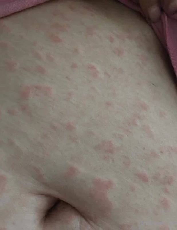 Urtikariálne prejavy na koži brucha u pacientky č. 1 (použité so súhlasom pacientky, archív autorov).