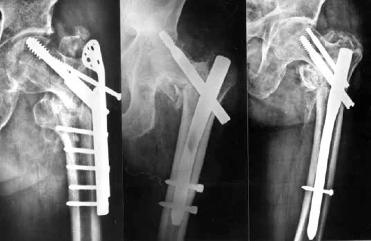 Mechanické selhání osteosyntézy u trochanterických zlomenin