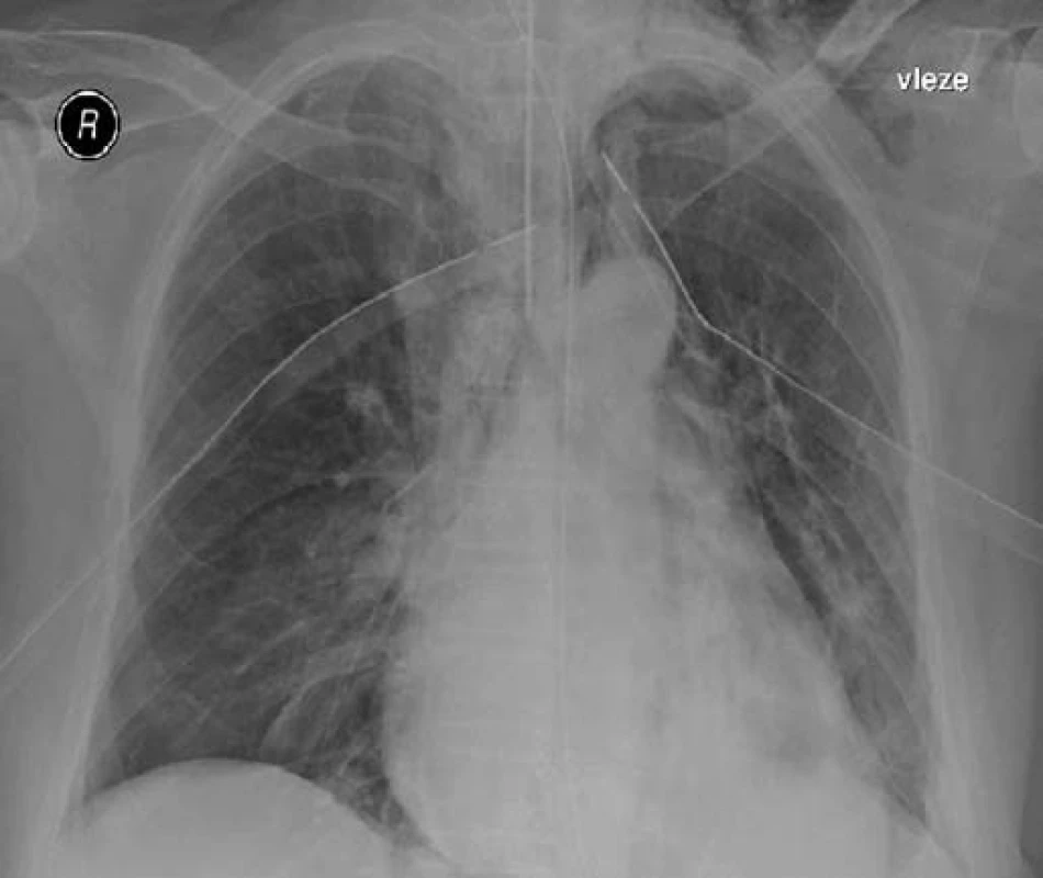 RTG plic po zavedení hrudních drénů.
Fig. 3. Chest X-ray of the lungs after the introduction of chest tubes.