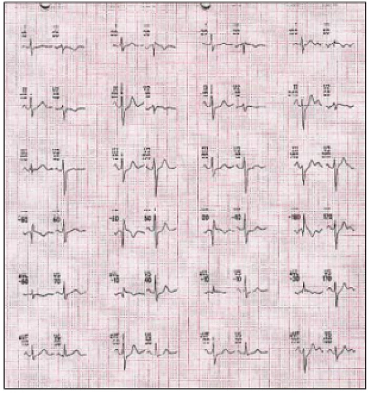 Elektrokardiografický záznam (EKG) zátěžového testu na bicyklovém ergometru z 13. 2. 2003. Subjektivně v průběhu tělesné zátěže i zotavení bez bolestí na hrudi.