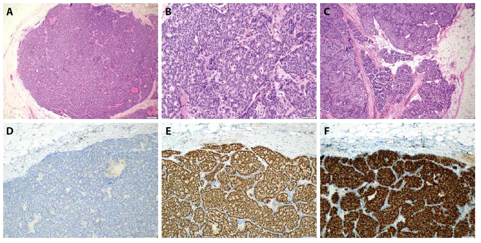 Solidní papilární karcinom (SPC). A. V přehledu solidní formace SPC s jemnými papilami (HαE, zvětšení 40x). B. Detail na monomorfní neoplastickou populaci s rozetovitými formacemi oddělenými jemným stromatem fibrózních papil (HαE, zvětšení 200x). C. Invazivní SPC se zachycením invaze v tukové tkáni v podobě „skládačky puzzle“ (horní část obrázku) a mikropapilární morfologií (dolní část obrázku) (HαE, zvětšení 40x). D. Kompletní absence CK5 v neinvazivní oblasti SPC (CK5, zvětšení 100x). E. Difuzní exprese ER v neinvazivní oblasti SPC (ER, zvětšení 100x). F. Přítomna je difuzní exprese neuroendokrinních márkrů, zde zachycen chromogranin A (chromogranin A, zvětšení 100x).