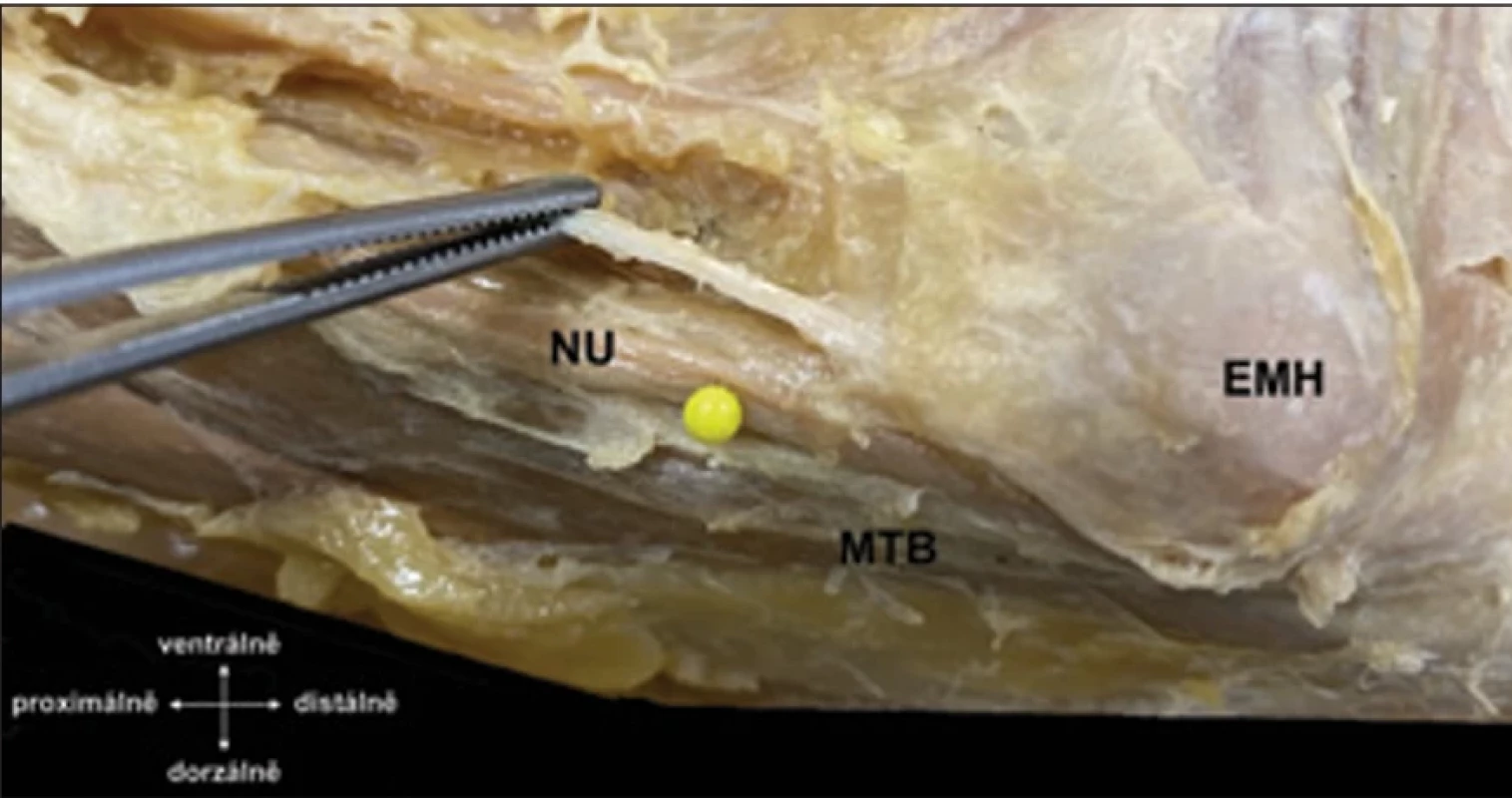 Nervus ulnaris (žlutá značka) v oblasti distální části paže před vstupem do sulcus  nervi ulnaris. V pinzetě septum intermusculare brachii mediale ventrálně od nervu, upí nající se na epicondylus medialis humeri.  Fig. 3. Nervus ulnaris (marked in yellow) in the distal part of the arm before entering the  sulcus nervi ulnaris. The forceps hold the septum intermusculare brachii mediale ventra lly from the nerve, which attaches to the epicondylus medialis humeri.