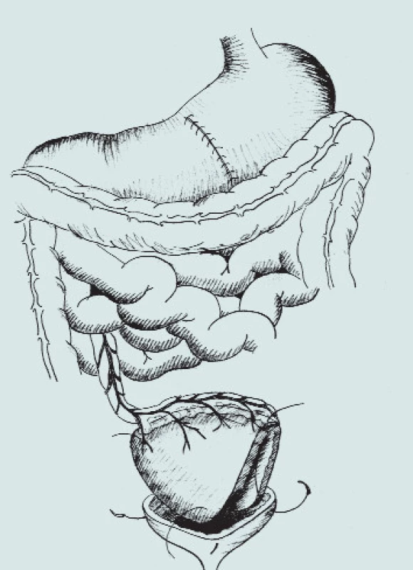 Gastrocystoplastika.
(A – klínovitá resekce těla žaludku s bází na velké kurvatuře, B – mobilizace segmentu žaludku s ponecháním výživy pravou gastroepiploickou arterií, C – transpozice segmentu žaludku do pánve a anastomóza s močovým měchýřem)