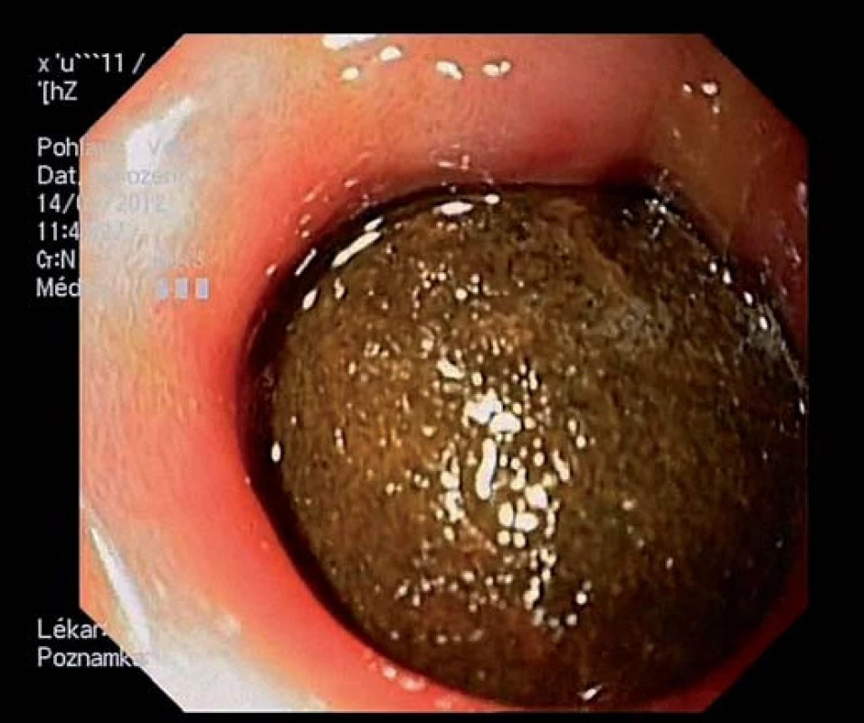 Objemný konkrement obturující lumen duodena.
Fig. 2. Large concrement obturating the lumen of duodenum.