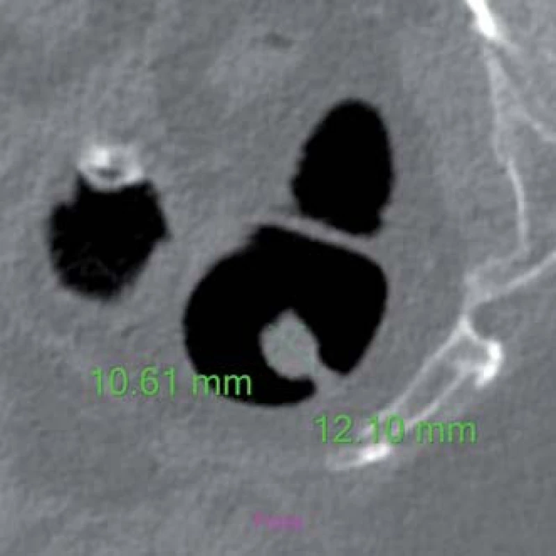 Stopkatý polyp rekta na CTC – dvojrozměrný obraz.
Fig. 1. Pedunculated rectal polyp on CTC – two-dimensional imaging.