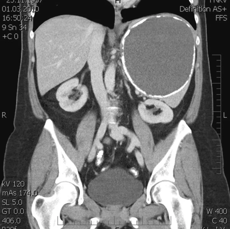 Poúrazová pseudocysta sleziny v CT scanu – koronární řez
Fig. 2. Post-traumatic pseudocyst of the spleen on CT scan – coronary section