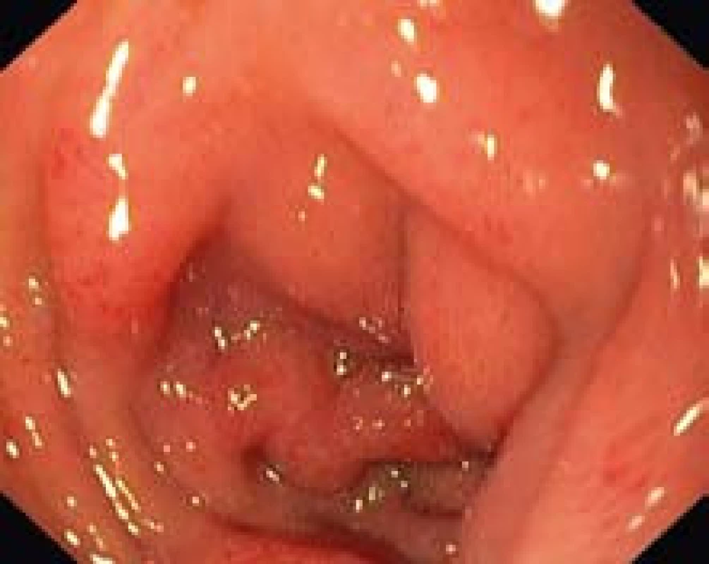 Edém a petechie v duodenu.
Fig. 1. Oedema and petechiae in the duodenum.