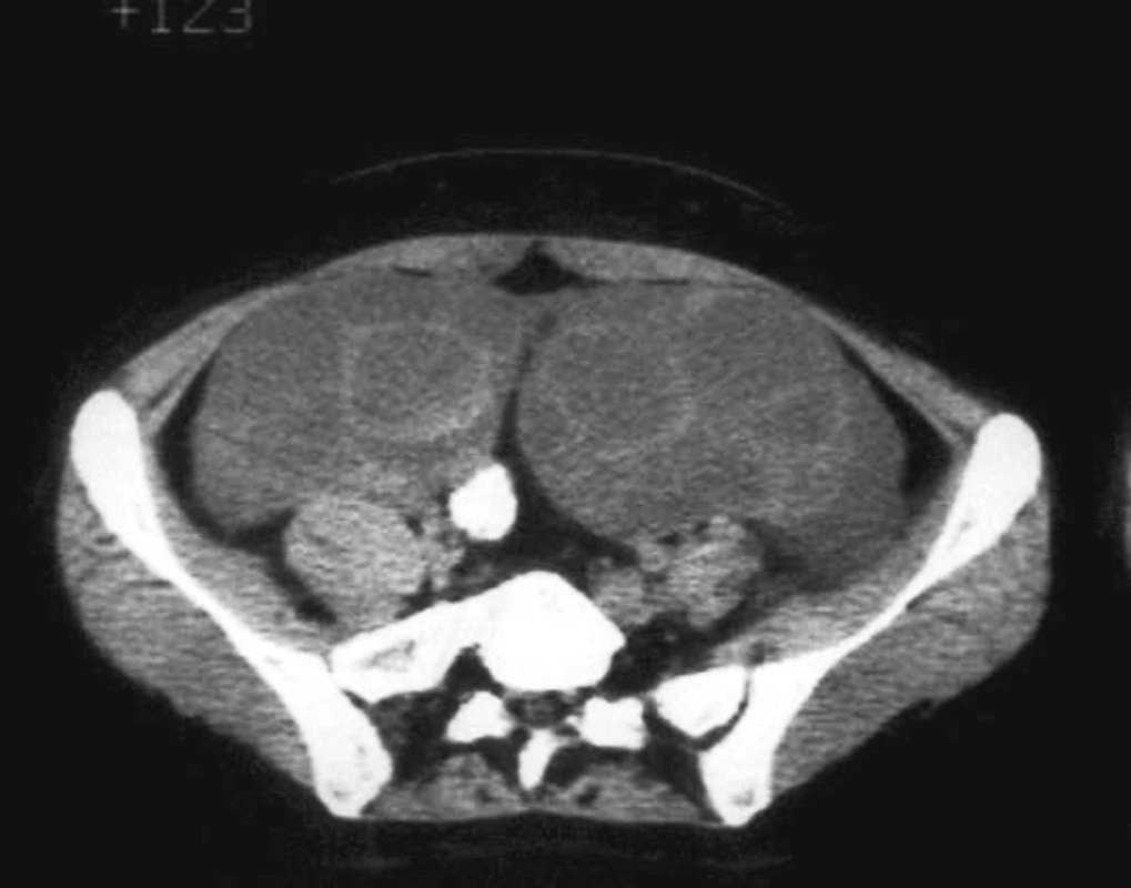 Počítačová tomografia: abdomen s multicystickým tumorom a slabo sa sýtiacimi septami
Fig. 2. Computed tomography: abdomen with multicystic tumor and poorly enhanced septae